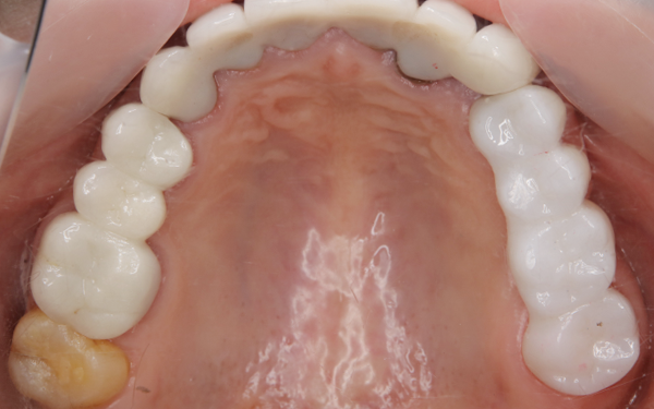 セラミック治療 ビフォー