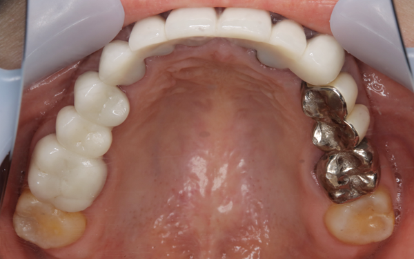 セラミック治療 アフター