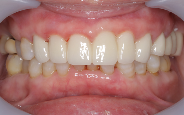 セラミック治療 アフター