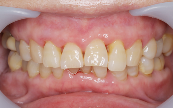 セラミック治療 ビフォー