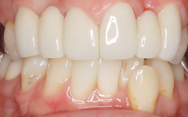 セラミック治療 アフター