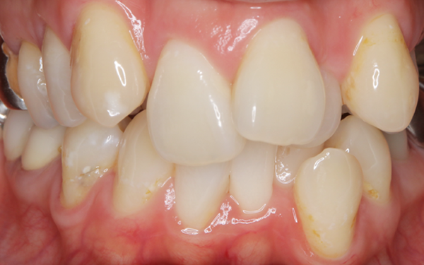 セラミック治療 ビフォー