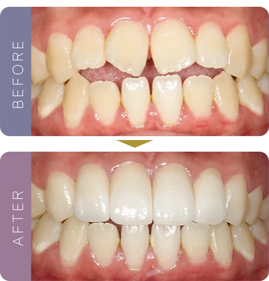 before after